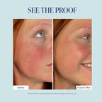 Before and after facial skin comparison of a woman with red hair, showing skin improvement on her cheek, under the text 'SEE THE PROOF' on a light blue background.