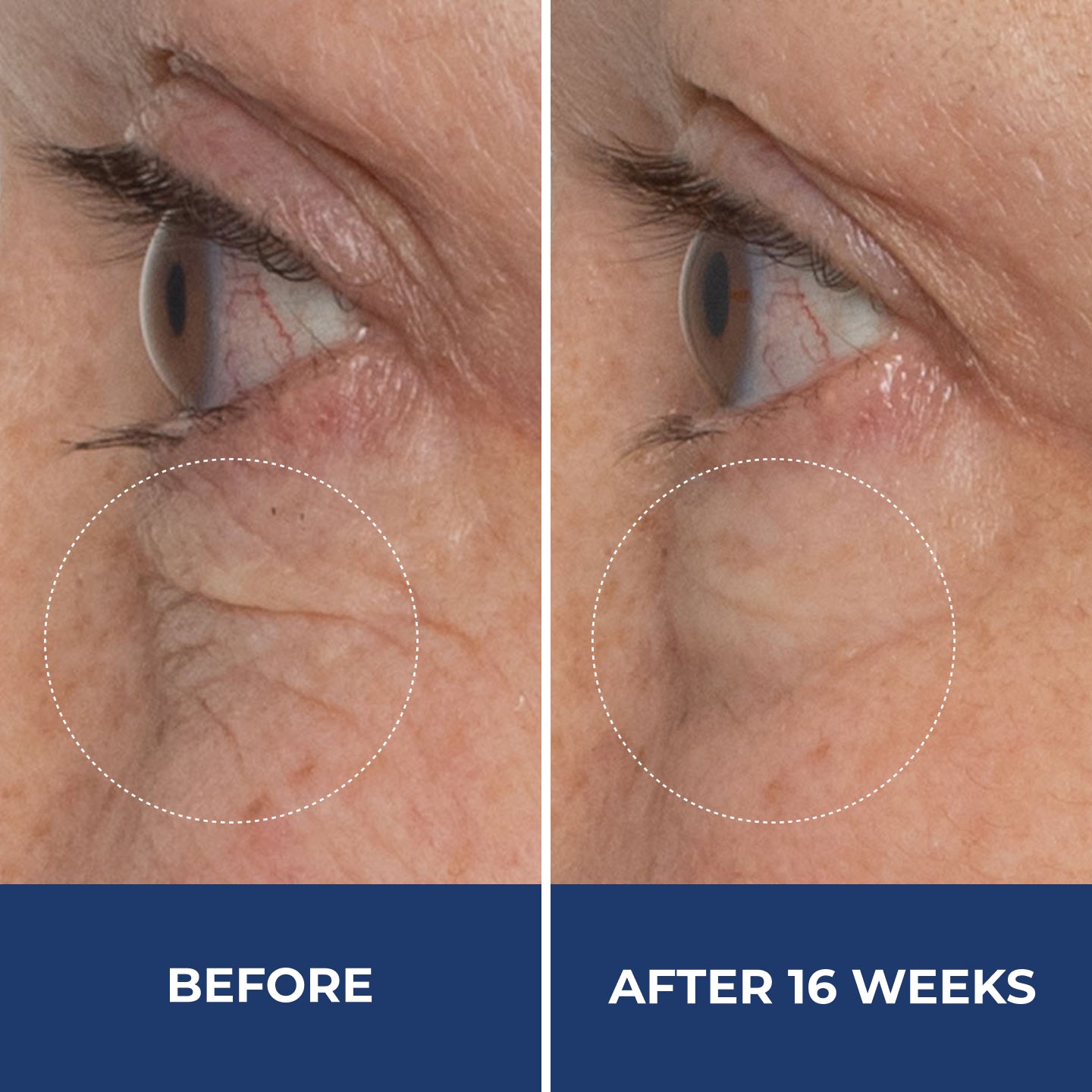 Before and after comparison of eye area with visible wrinkles, labeled 'Before' and 'After 16 Weeks'.